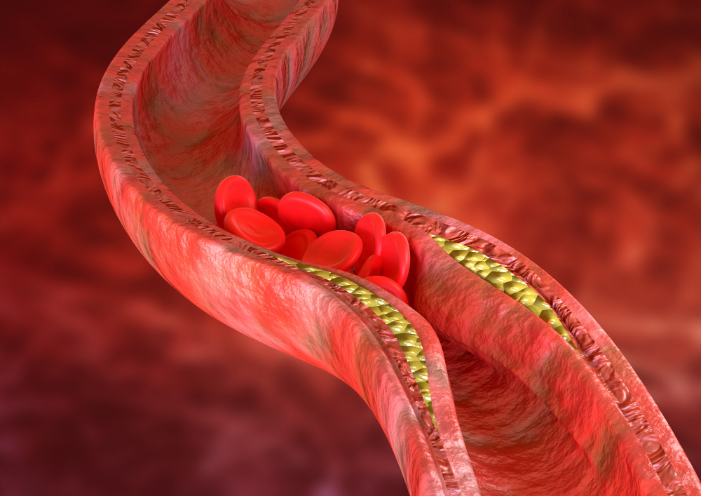 Doença Arterial Obstrutiva Periférica
