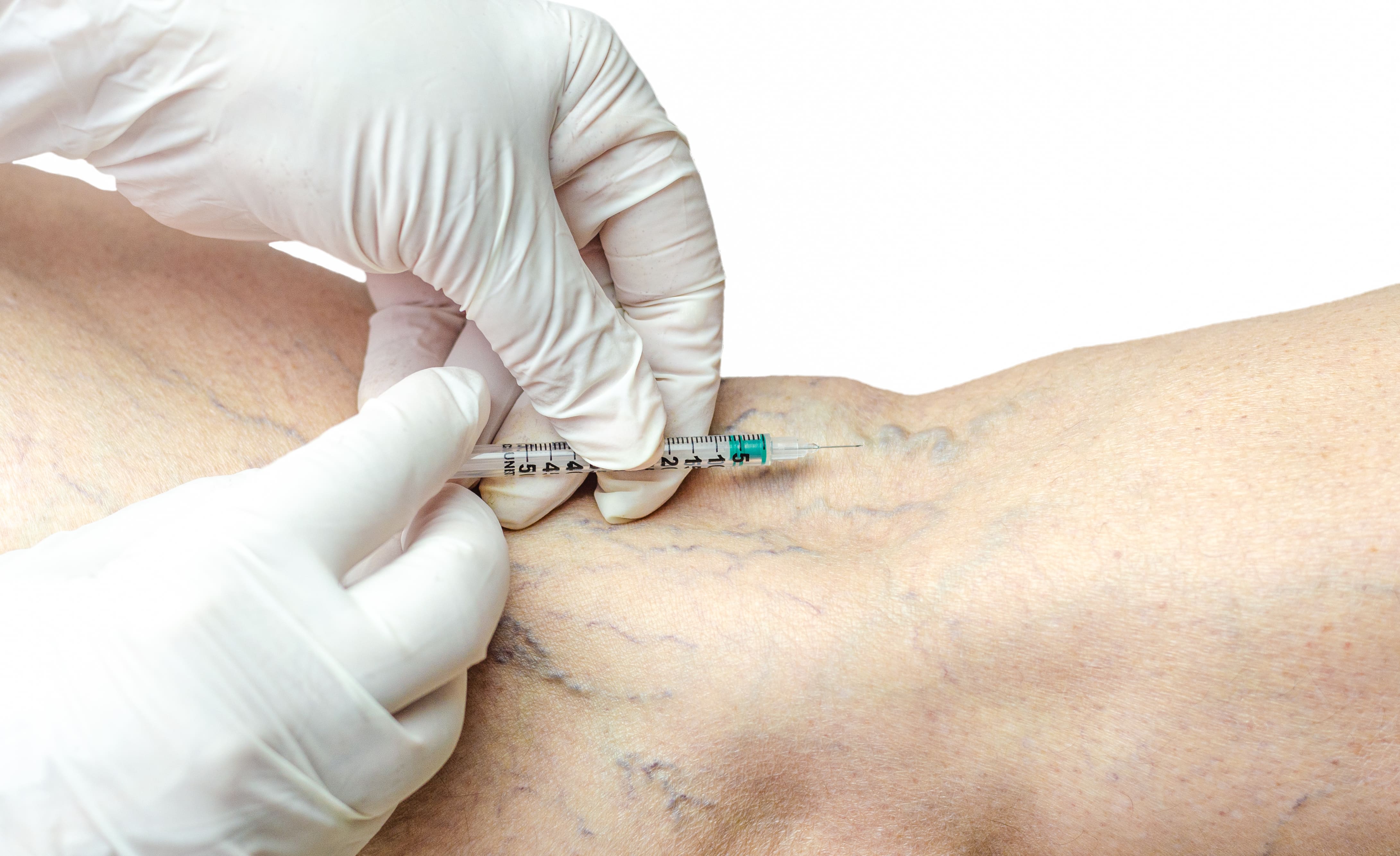 Escleroterapia com Espuma