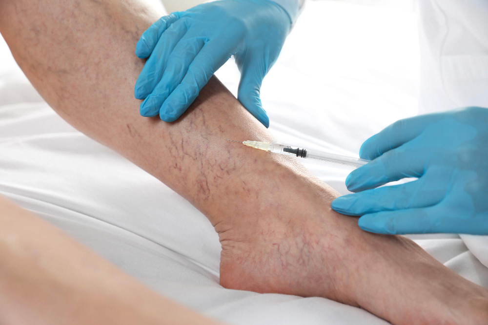 Escleroterapia com Glicose