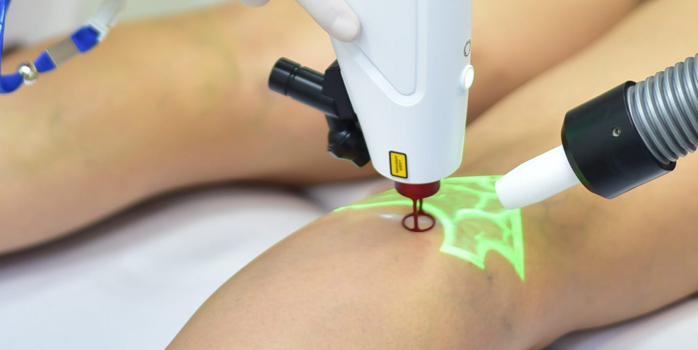 Escleroterapia a Laser