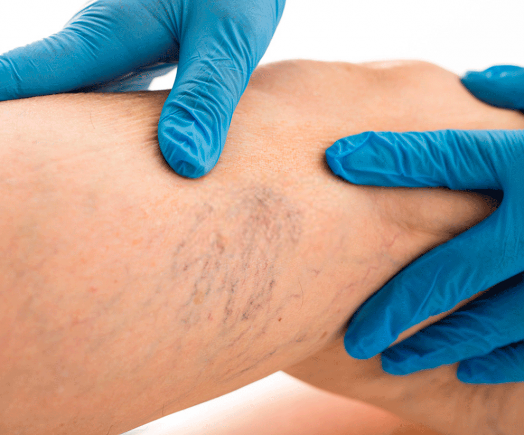 Microcirurgia de Varizes